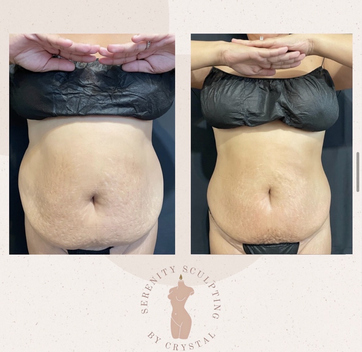 Before and after — belly contouring