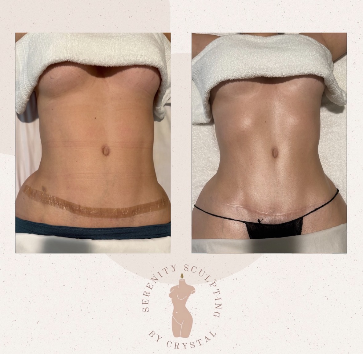 Before and after — waist sculpting