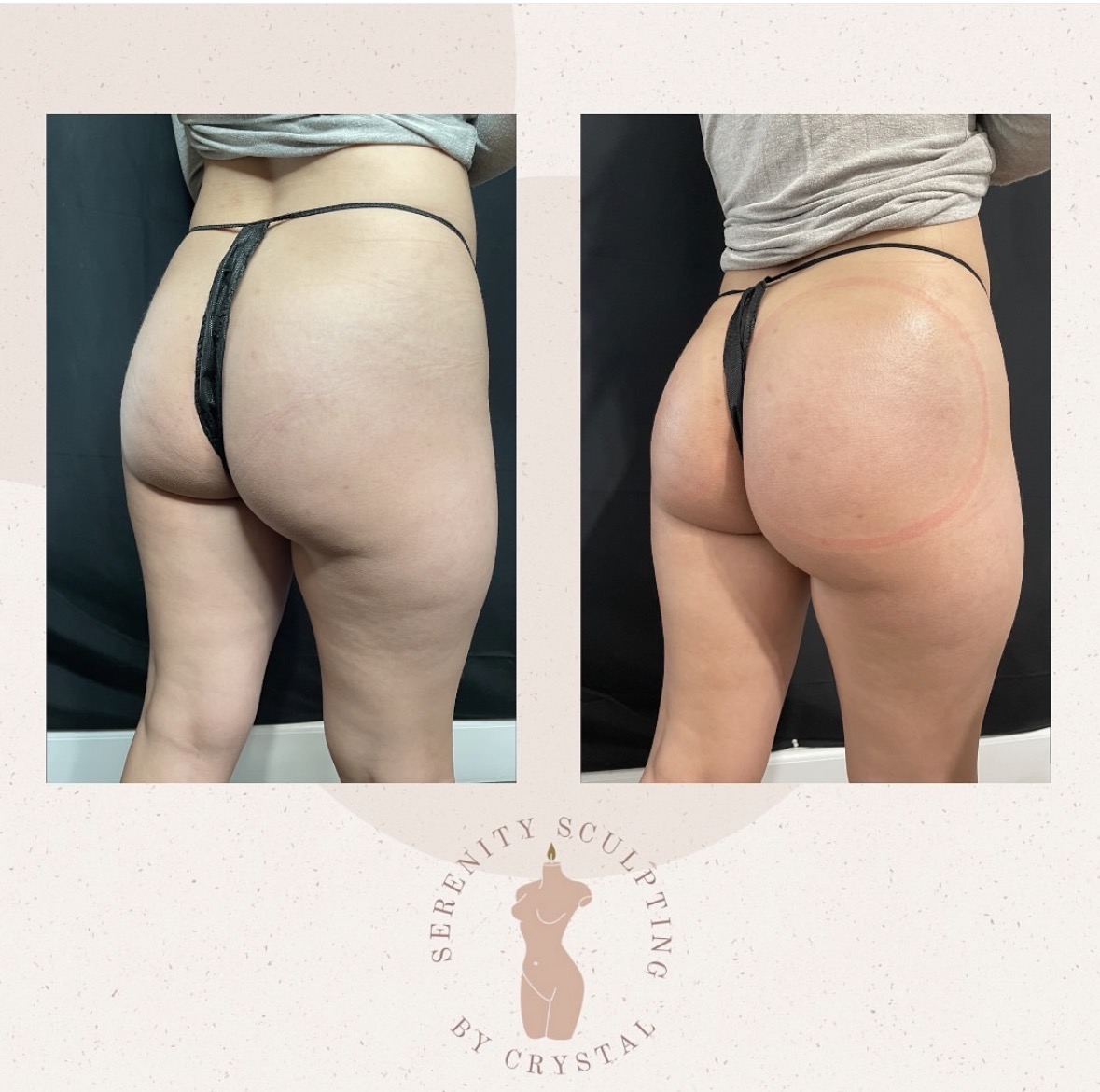 Before and after — vacuum therapy BBL