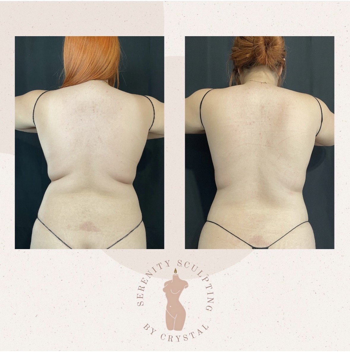 Before and after — back contouring